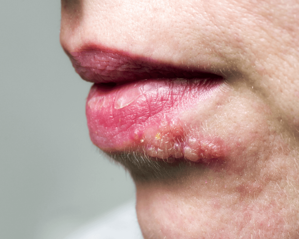 L'herpès labial, ou feu sauvage, forme des vésicule remplies de liquide au niveau de la lèvre. 